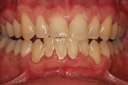 Photo of a patient with gingivitis